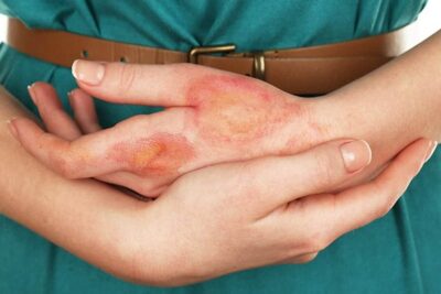 پماد 30گرم آلفا