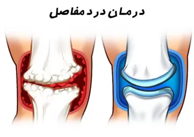 کپسول آوسوی 20 عددی بی اس کی