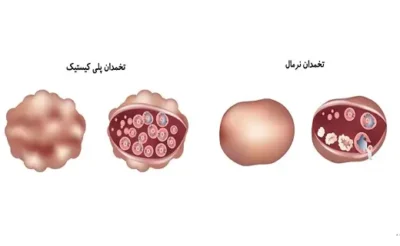 ساشه اوازیتول دارو درمان پارمیدا 30 عدد