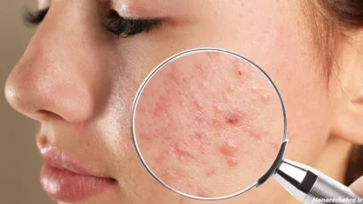 کرم آزلاِئیک اسید اکتی ویت ویتالایر