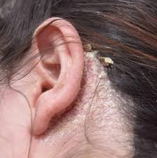 شامپو پوست سر خیلی خشک ساین اسکالپ